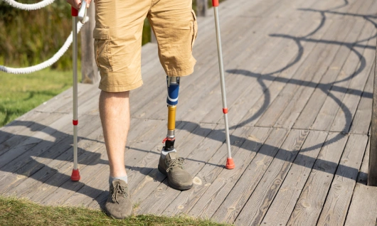 Amputation Injuries