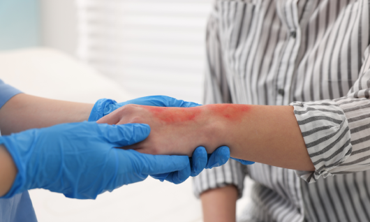 Burn Injury